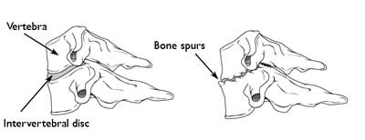 Cervical Radiculopathy (Pinched Nerve)